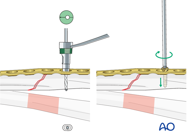 Fixation – compression plating with an additional lag screw