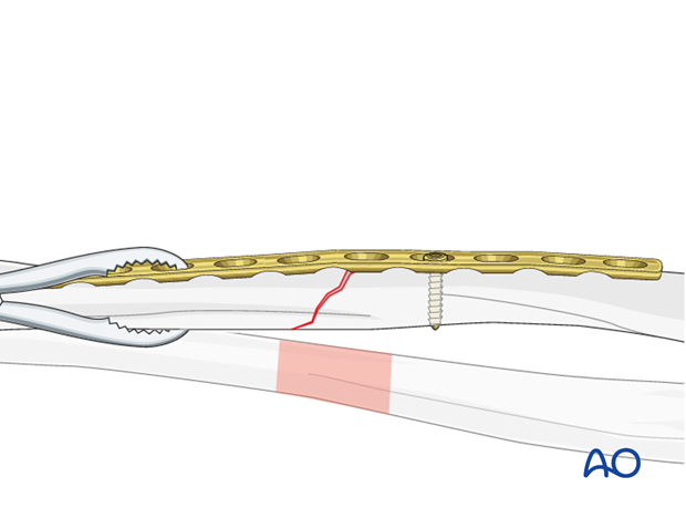 Fixation – compression plating with an additional lag screw