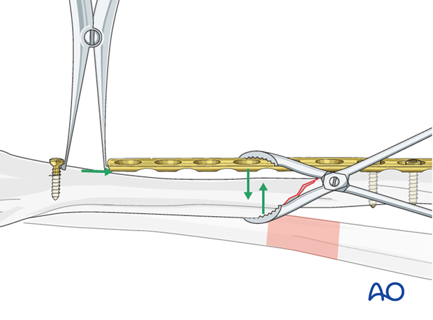 Fixation – compression plating with an additional lag screw