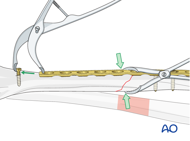 Fixation – compression plating with an additional lag screw