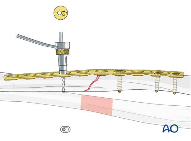 Fixation – compression plating with an additional lag screw