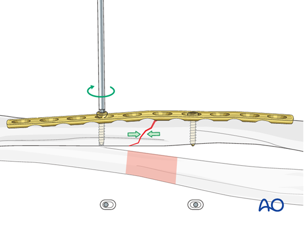 Fixation – compression plating with an additional lag screw