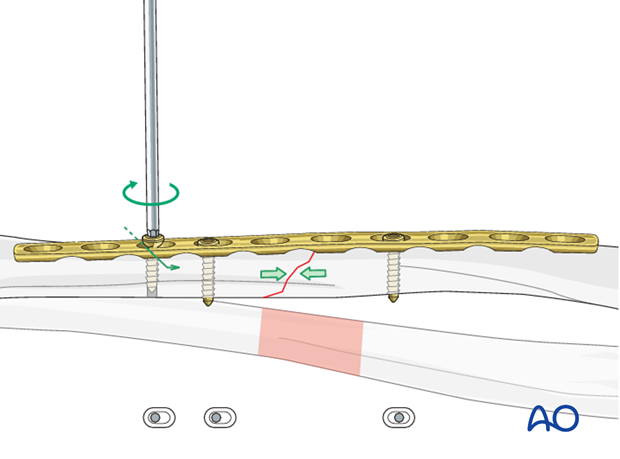 Fixation – compression plating with an additional lag screw