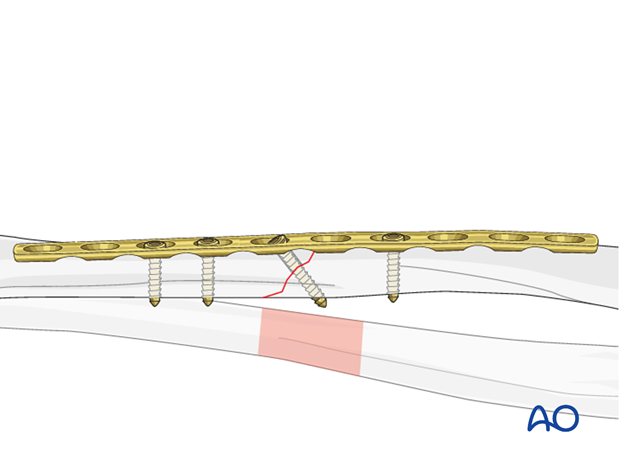 Fixation – compression plating with an additional lag screw