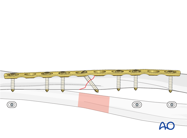 Fixation – compression plating with an additional lag screw