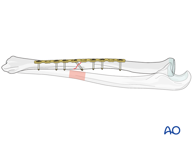 Fixation – compression plating with an additional lag screw