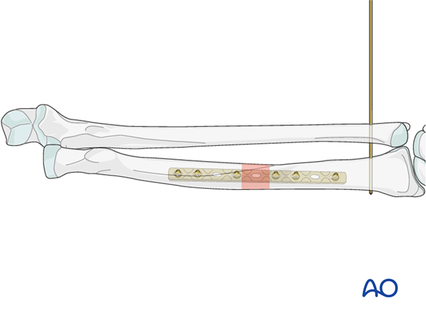 Galeazzi fracture-dislocation