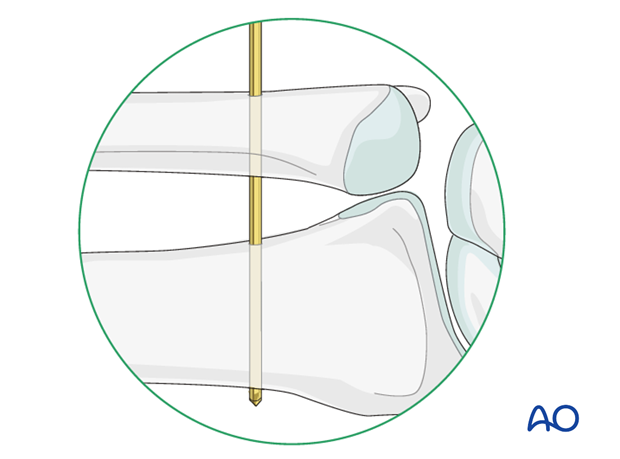 Galeazzi fracture-dislocation