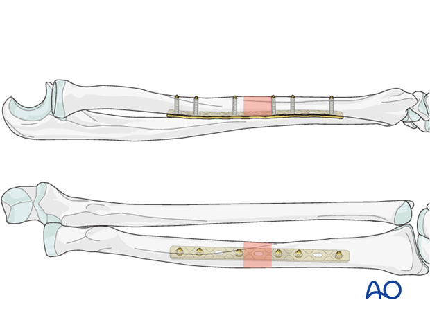 Galeazzi fracture-dislocation