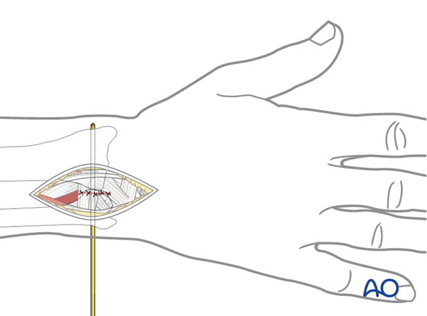 Galeazzi fracture-dislocation