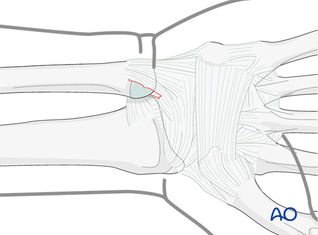 Galeazzi fracture-dislocation