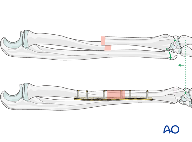 Galeazzi fracture-dislocation