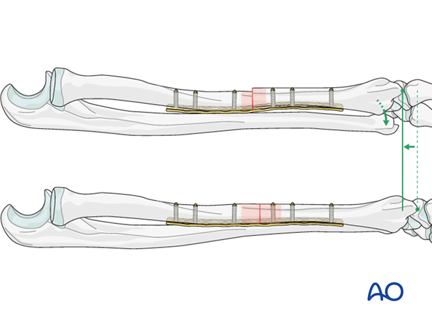 Galeazzi fracture-dislocation