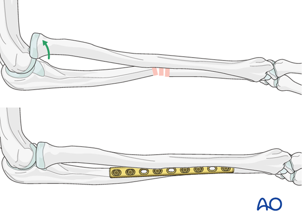 radial head stabilization monteggia fracture dislocation