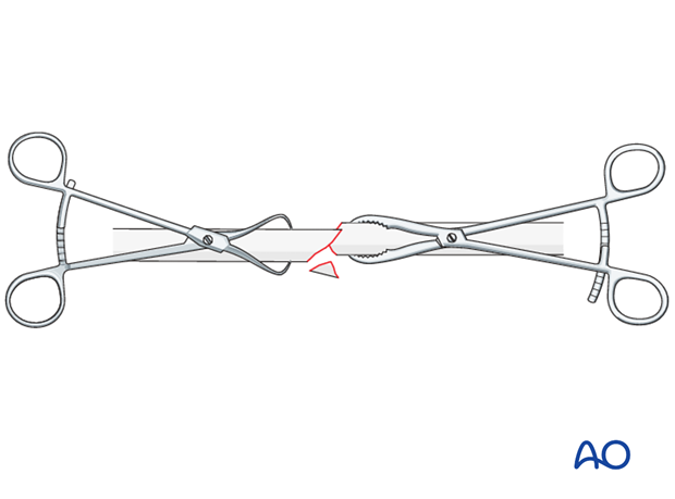 No direct fixation of the wedge fragment