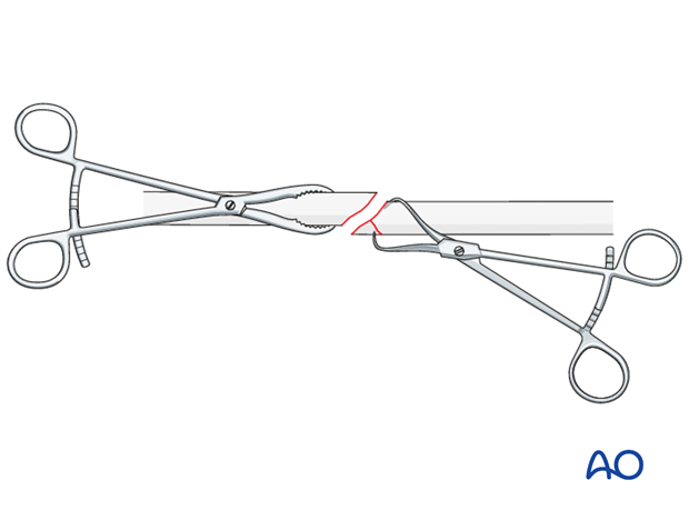 No direct fixation of the wedge fragment