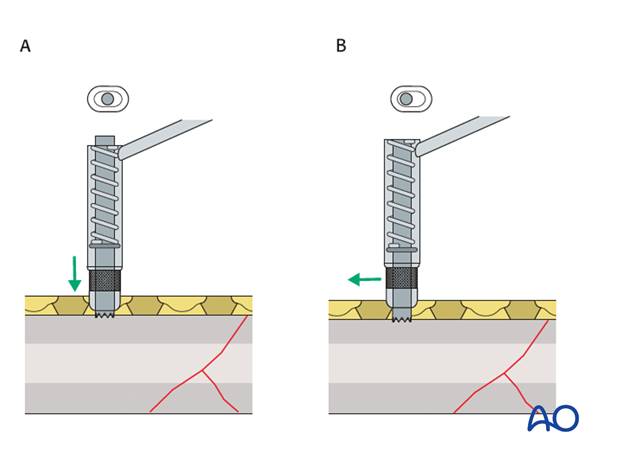 No direct fixation of the wedge fragment