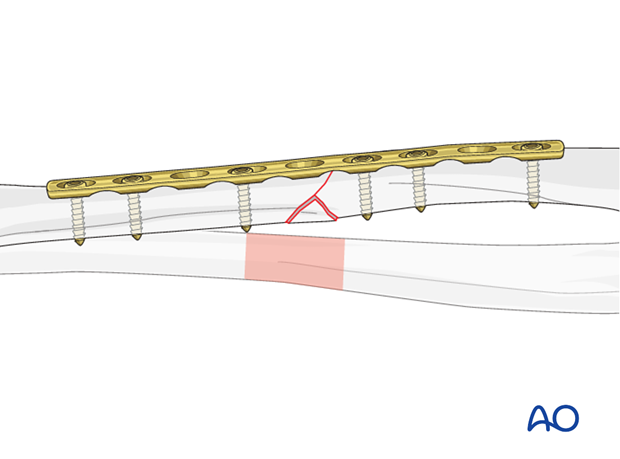 Plate position, length and number of screws