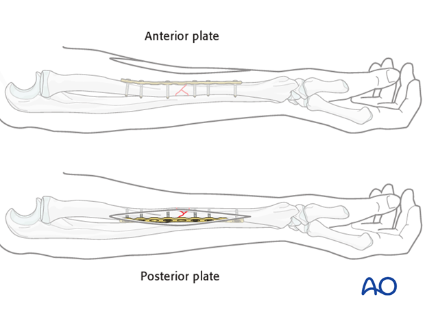 Plate position, length and number of screws