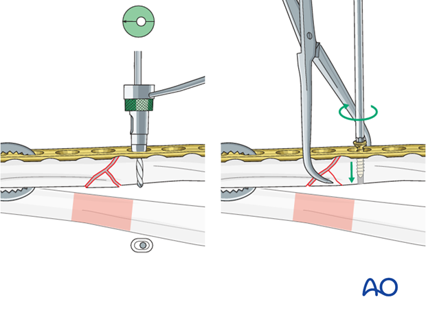 No direct fixation of the wedge fragment