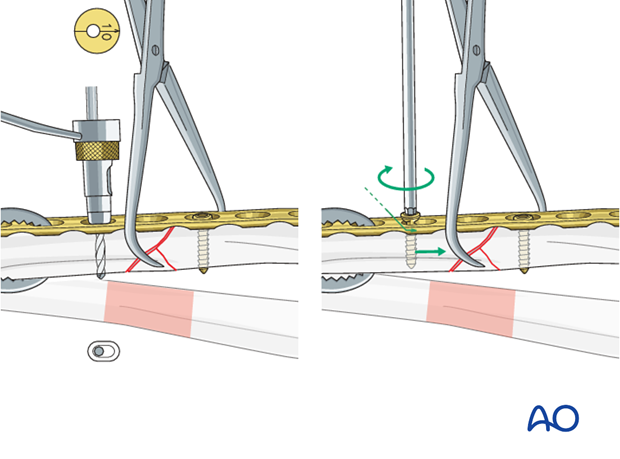 No direct fixation of the wedge fragment