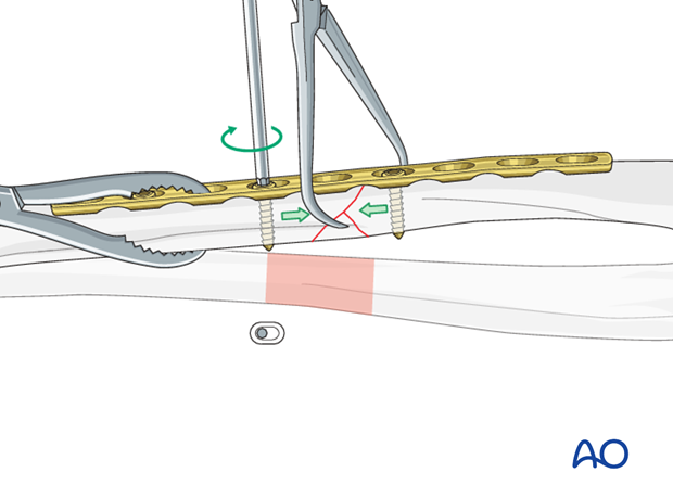 No direct fixation of the wedge fragment