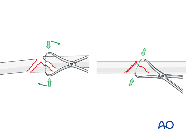 Fixation of the wedge fragment with a lag screw through the plate.