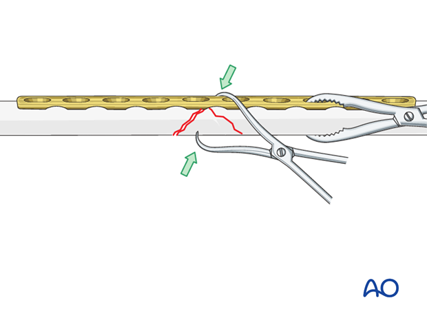 Fixation of the wedge fragment with a lag screw through the plate.