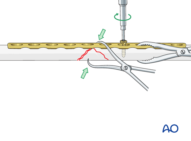 Fixation of the wedge fragment with a lag screw through the plate.