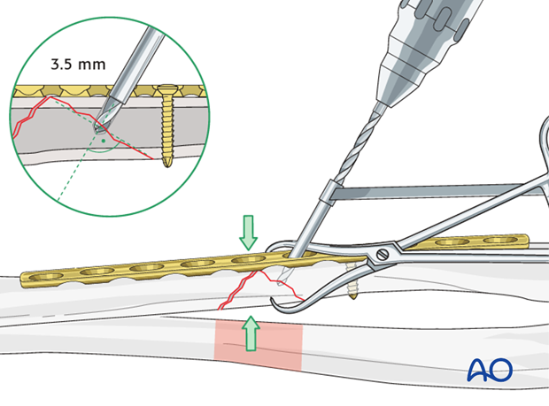 Fixation of the wedge fragment with a lag screw through the plate.