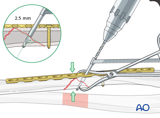 Fixation of the wedge fragment with a lag screw through the plate.