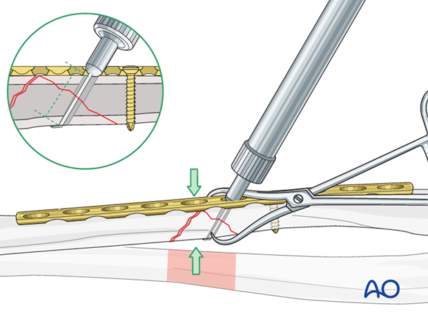 Fixation of the wedge fragment with a lag screw through the plate.