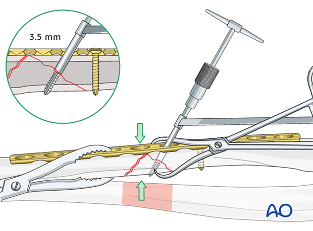 Fixation of the wedge fragment with a lag screw through the plate.