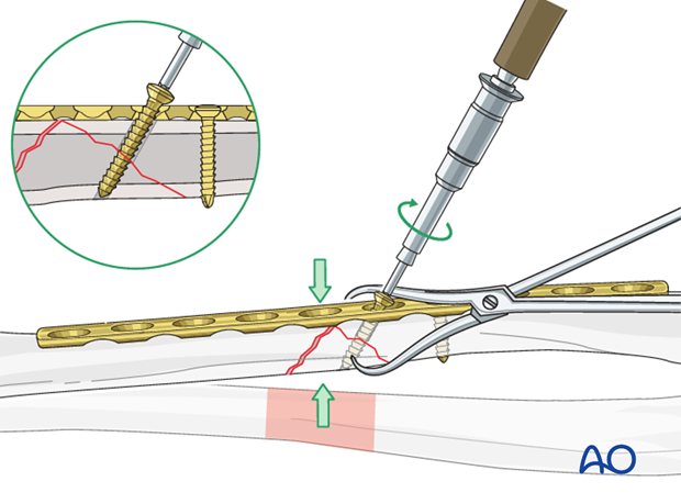 Fixation of the wedge fragment with a lag screw through the plate.