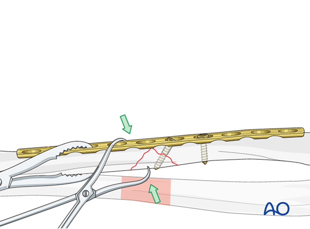 Fixation of the wedge fragment with a lag screw through the plate.