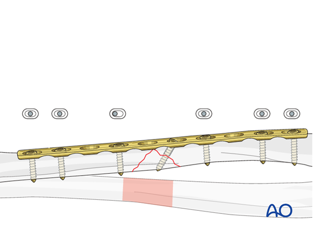 Fixation of the wedge fragment with a lag screw through the plate.