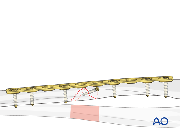 Fixation of the wedge fragment with a separate lag screw