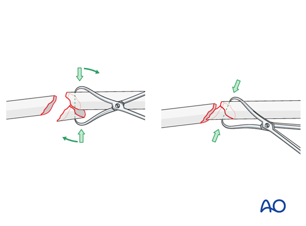 Fixation of the wedge fragment with a separate lag screw