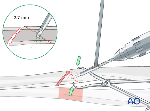 Fixation of the wedge fragment with a separate lag screw