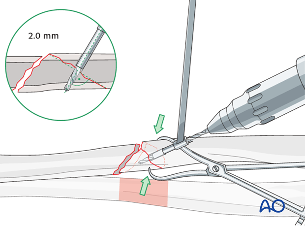 Fixation of the wedge fragment with a separate lag screw