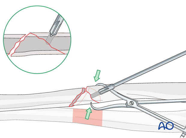 Fixation of the wedge fragment with a separate lag screw