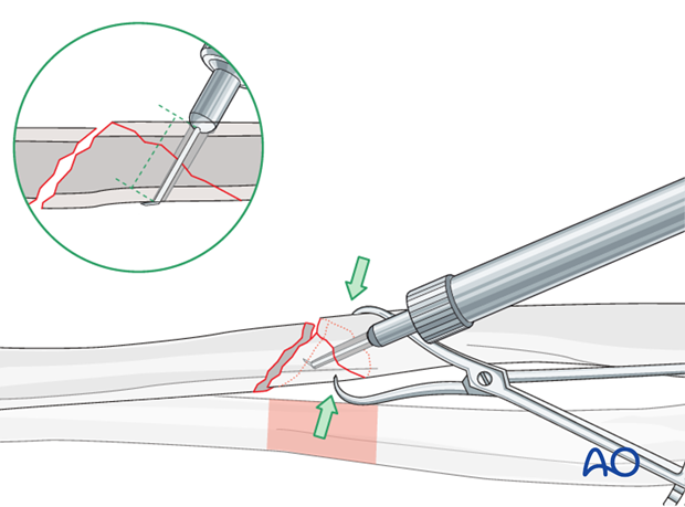 Fixation of the wedge fragment with a separate lag screw