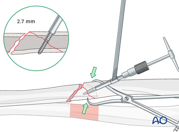 Fixation of the wedge fragment with a separate lag screw