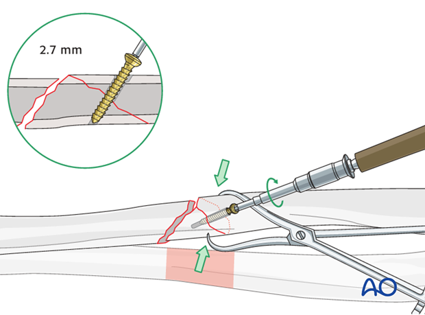 Fixation of the wedge fragment with a separate lag screw