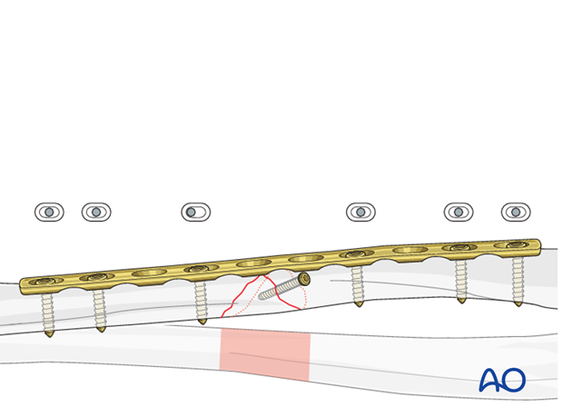 Fixation of the wedge fragment with a separate lag screw