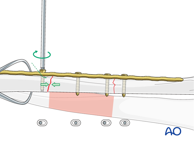 Second fracture fixation