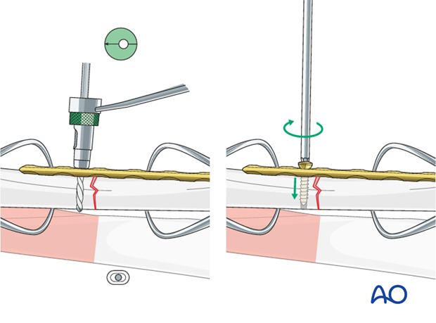 Neutral screw insertion