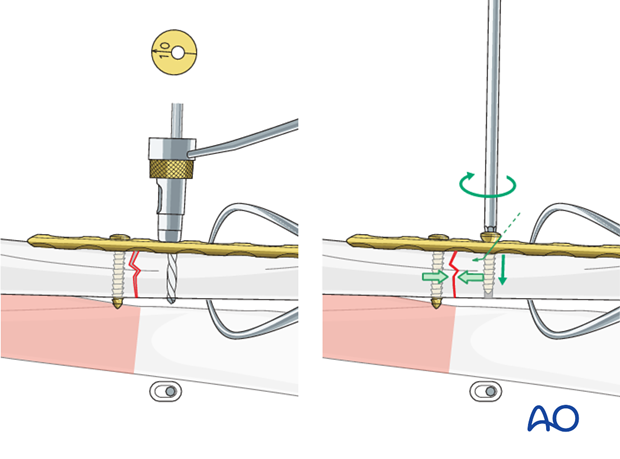 Load screw insertion