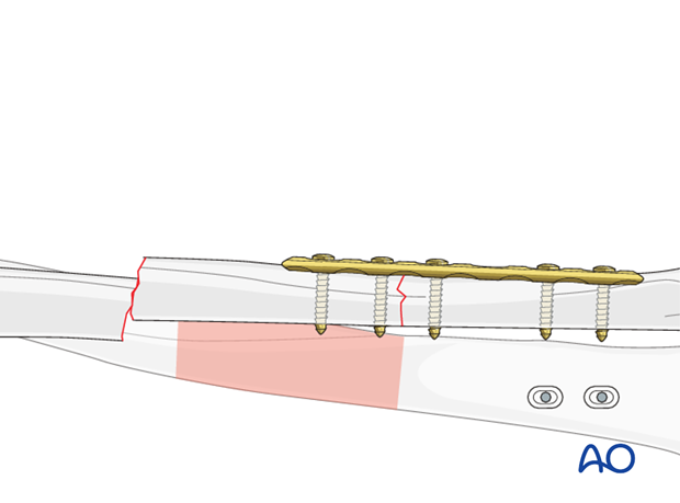 Secure first fracture fixation