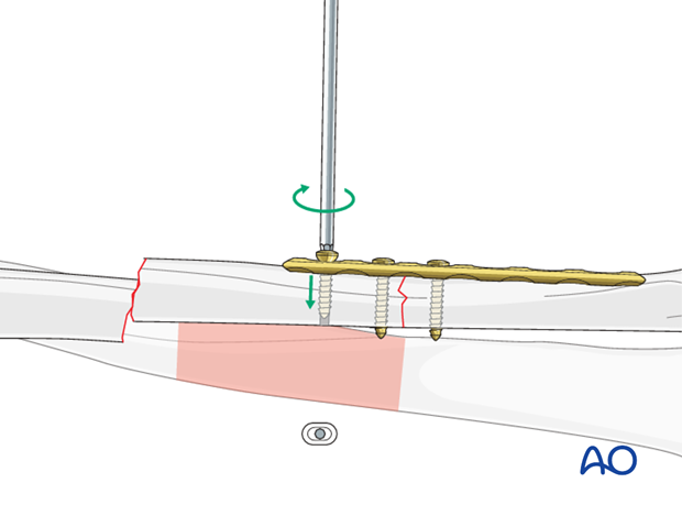 Additional screw insertion